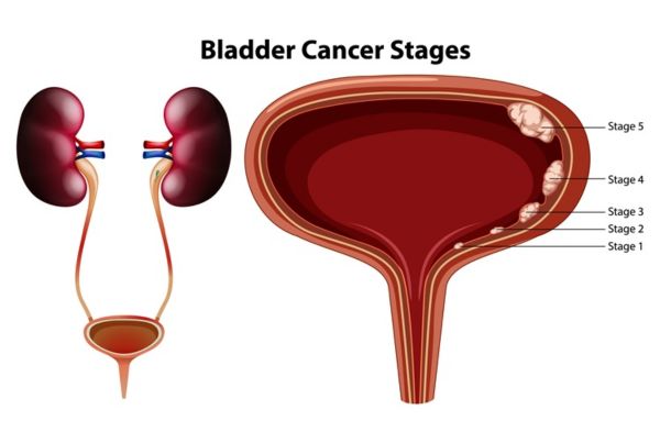 Bladder Cancer